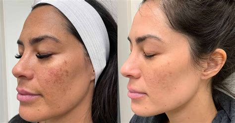 skin peel ballito